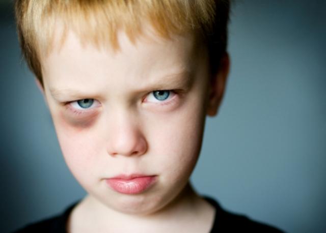 как быстро убрать синяк под глазом в домашних условиях Kak Ubrat Sinyak Pod Glazom Ot Udara Wmj Ru