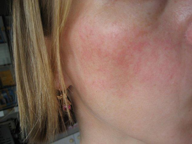 как убрать лопнувшие сосуды на лице в домашних условиях отзывы Lechenie Sosudistyh Zvezdochek Narodnymi Sredstvami Wmj Ru