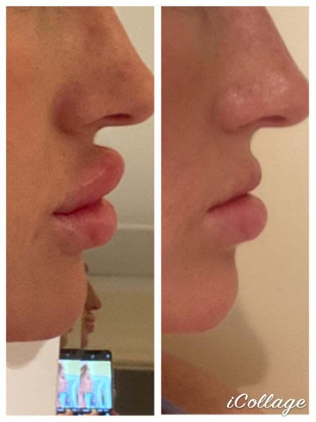 Накаченные губы до и после. Ева князева муклы. Утиные губы после увеличения. Утиные губы после увеличения. Утиные губы после увеличения.