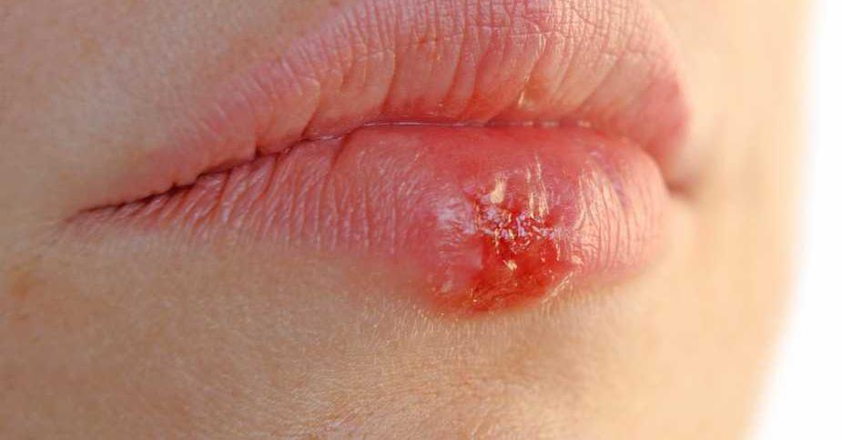 Как ускорить лечение герпеса губы thumbnail